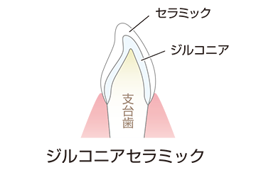 イラスト ジルコニアセラミック