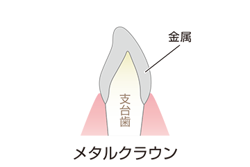 イラスト メタル