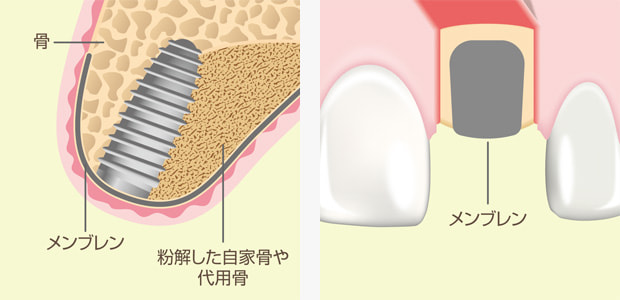 イラスト GBR法（骨誘導再生法）