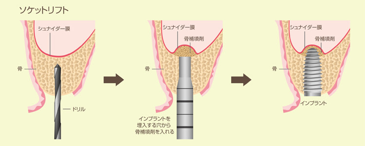 イラスト ソケットリフト法