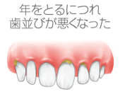 年をとるにつれ歯並びが悪くなった