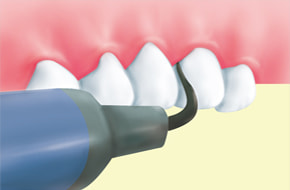 イラスト 1 歯石・歯垢の除去